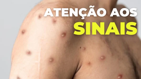 Sintomas de mpox